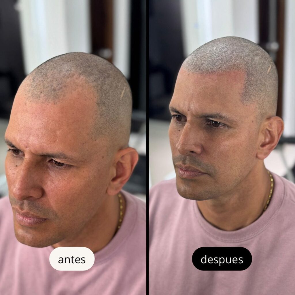 Antes y despues de la micropigmetación capilar